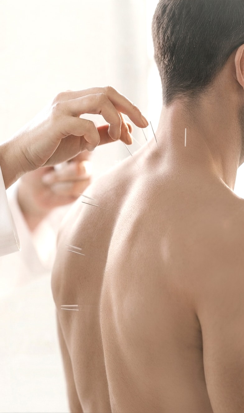 Acupuncture — BeHealth Medical Centre